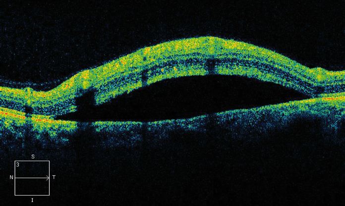 Окт глаза. Оптическая когерентная томография сетчатки глаза. Отслоение сетчатки томография. Отслойка сетчатки томография глаза. Окт сетчатки глаза.