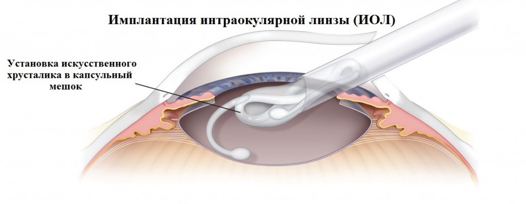 Линзы в глаза операция. Катаракта факоэмульсификация. Имплантация искусственного хрусталика. Катаракта имплантация ИОЛ. Имплантация факичных интраокулярных линз.