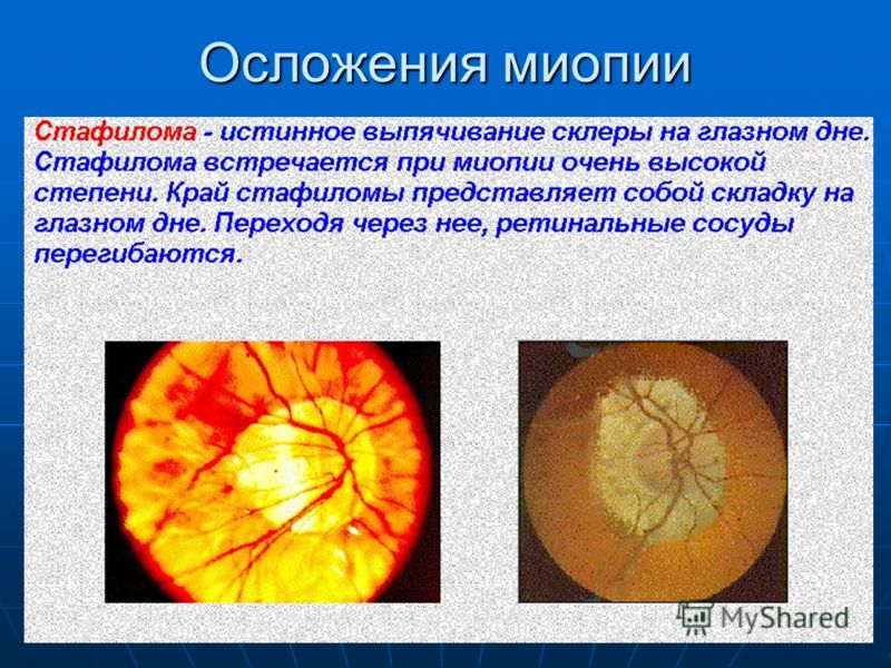 Миопия высокой степени. Миопический конус глазное дно. Миопическая стафилома сетчатки. Стафилома диска зрительного нерва.