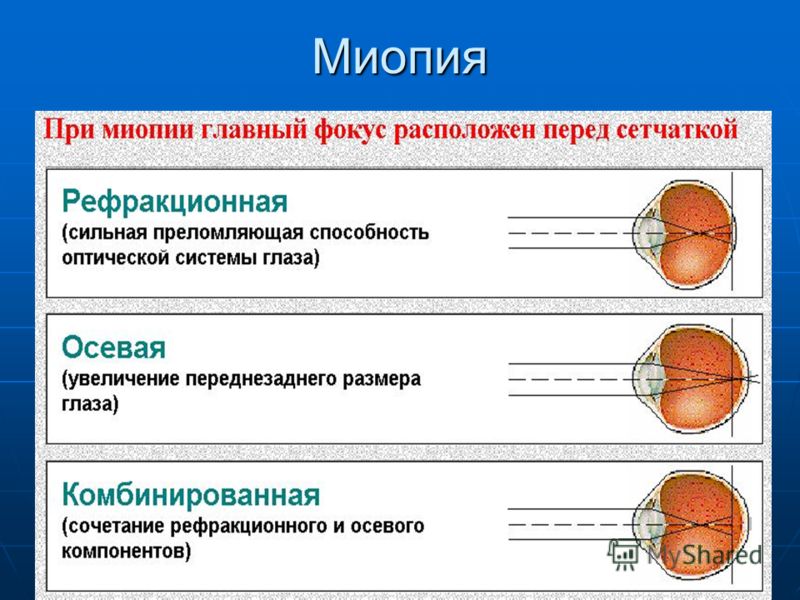 Формы близорукости. Классификация миопии осевая и рефракционная. Степени миопии классификация. Классификация близорукости. Осевая близорукость.