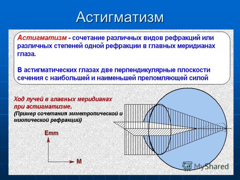 Астигматизм что. Астигматические линзы сфера цилиндр. Астигматизм. Рефракционный астигматизм. Пересчет линз АСТИГМАТИКА.