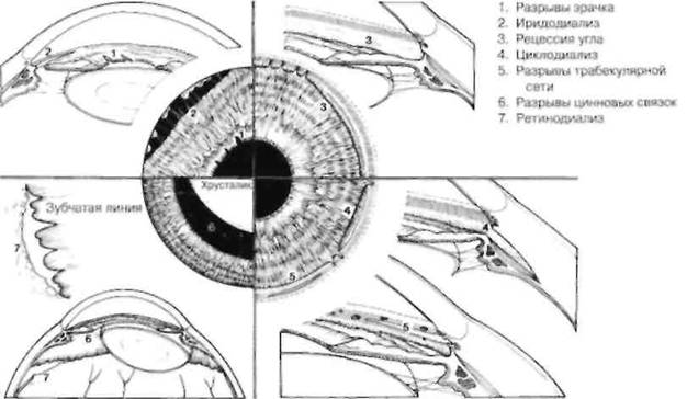 Передний сегмент. Синдром плоской Радужки. Глаукома с плоской радужкой. ПЗУГ С плоской радужкой. Окт передней камеры синдром плоской Радужки.